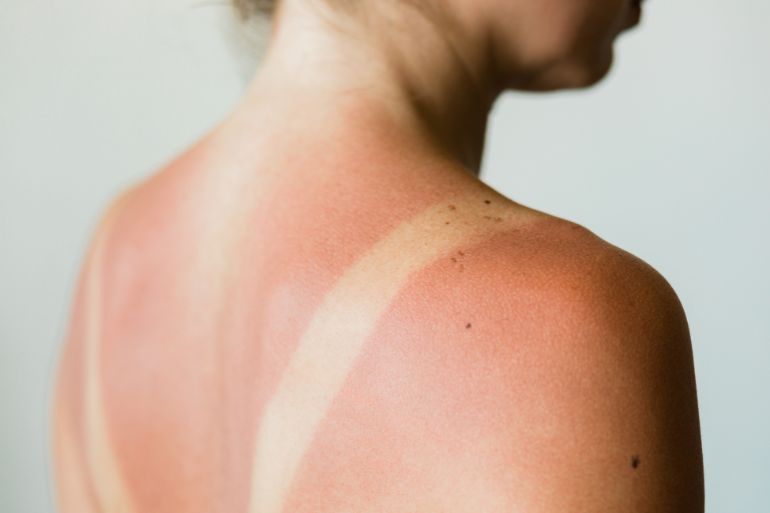 The Dos and Don’ts of Treating a Sunburn
