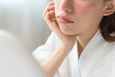 A woman with mild red irritation on her face looks at herself in a mirror. She has brown hair and wears a white robe.